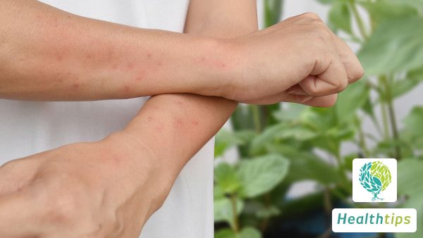 What are some alternative remedies for treating chronic eczema?