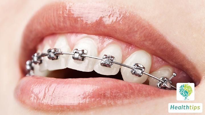 How much does an invisible braces cost approximately?