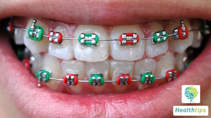 How much does it generally cost to wear braces?