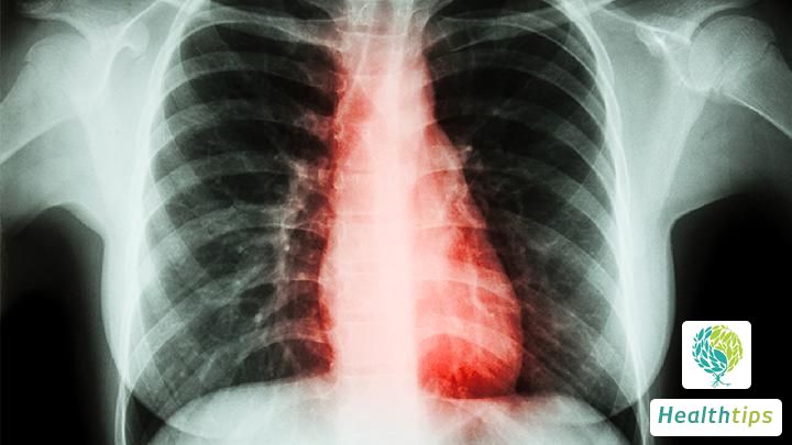 How Severe are the Long-Term Sequelae of SARS?