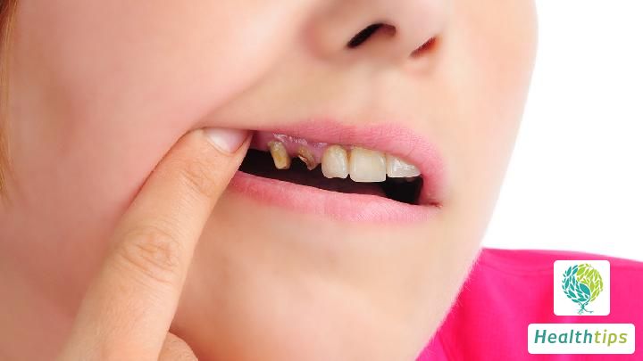 What is the term for filling gaps in childrens teeth?