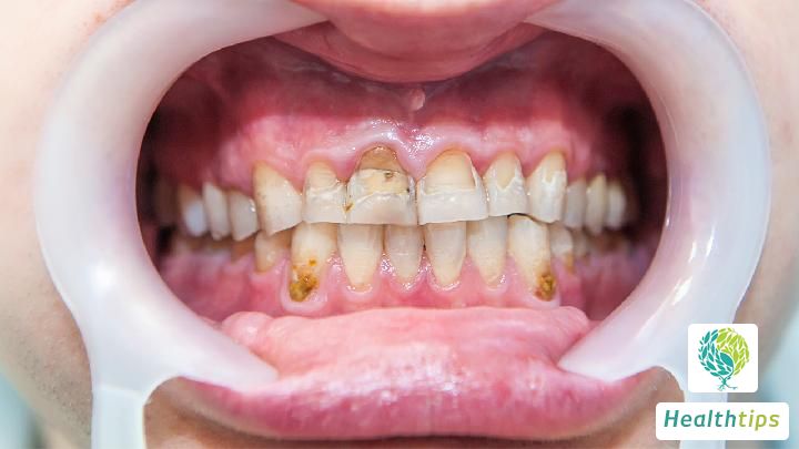 What medication is effective for quickly reducing swelling and pain caused by gum inflammation?