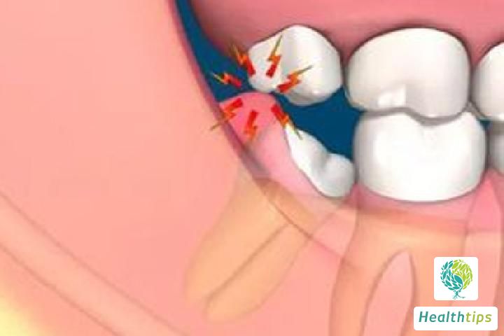 Should I Take Anti-Inflammatory Medication If My Wisdom Tooth Extraction Pain Persists After Five Days?