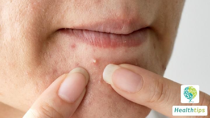 Why do I get hard pimples on my chin before menstruation?