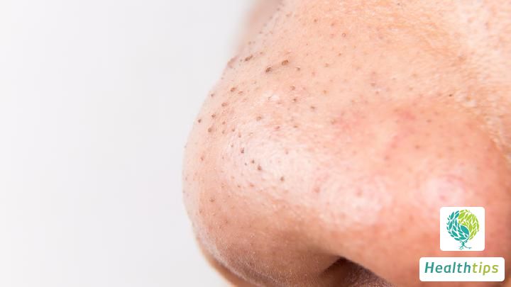 How Do I Remove Blackheads on My Nose and Face?