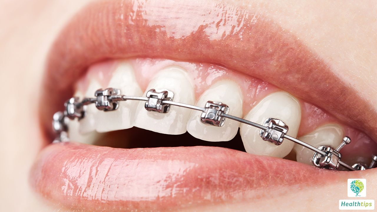 What is the Approximate Cost of Braces for Overbite Correction?