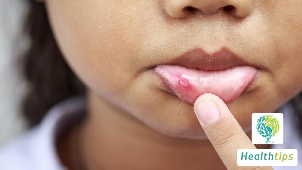 What Causes Tongue Tip Ulcers?