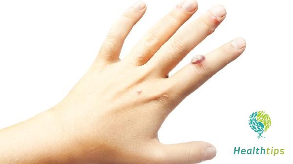 Can Skin Metal Allergies Be Treated?