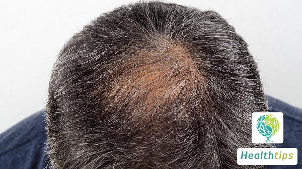 How to Treat Dandruff, Itchy Scalp, and Hair Loss?