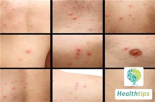 What Are the Symptoms of Having a Rash?