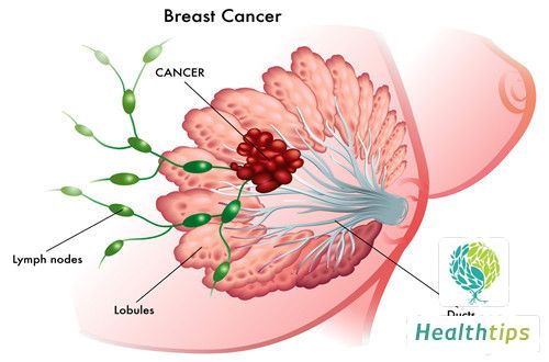 How to Eliminate the Lump Caused by Breast Inflammation?