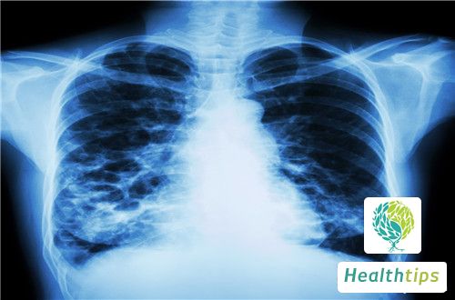 What are the Differences Between Pulmonary Fibrosis and Pulmonary Fibrotic Lesions?