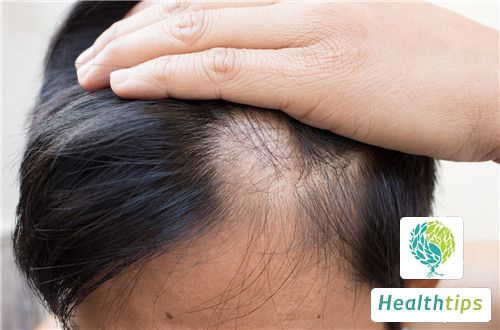 What Are the Causes of Hair Loss?