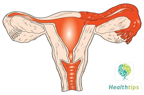 What Vegetables Are Good for Ovarian Cyst?