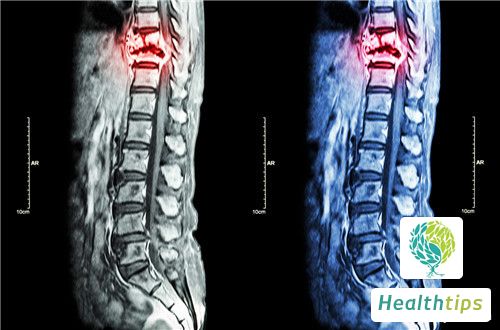 What Are the Optimal Exercises for Scoliosis?