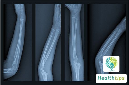 What Are the Recommended Three-Meal Meal Plans for Fracture Patients?