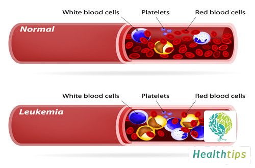 What are the Clinical Manifestations of Kala-azar?