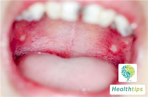 What Are the Initial Symptoms of Oral Syphilis?