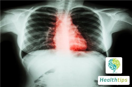 How to Differentiate and Diagnose Rheumatic Heart Disease?