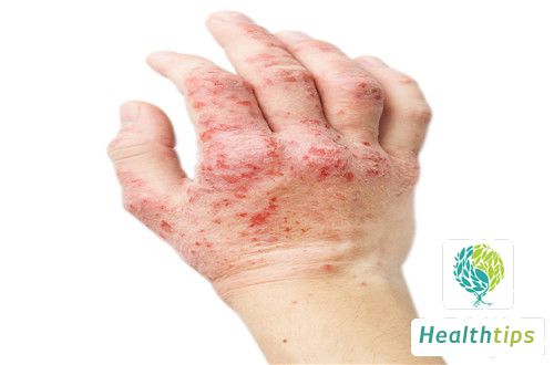 Old Remedies for Fungal Infections on the Hands: Any Effective Tricks?