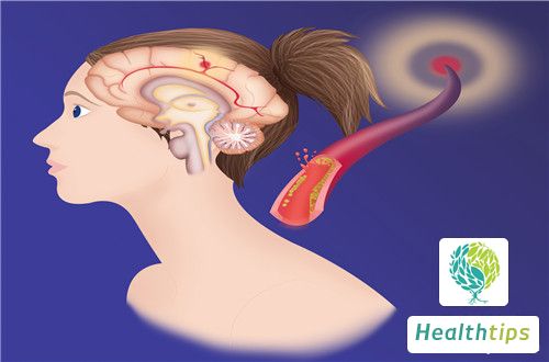 What Are the Clinical Manifestations of Cerebral Thrombosis?