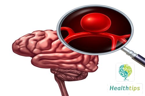 What are the Six Major Clinical Manifestations of Brain Stem Infarction?