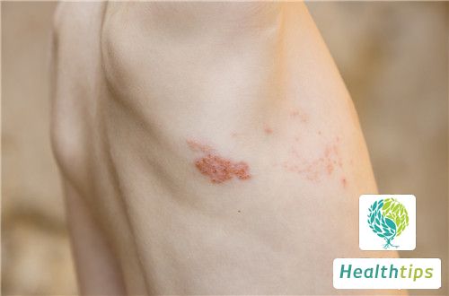 What Causes Herpes Infection?