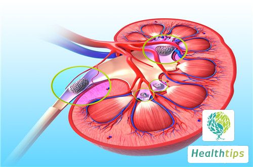 What Does Renal Insufficiency Mean?