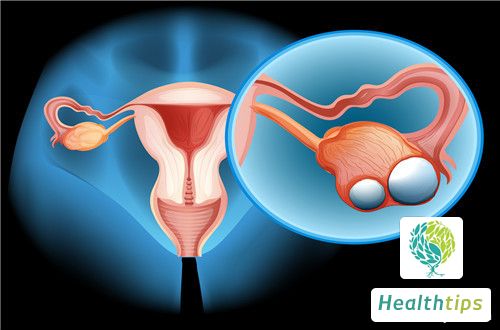 What Are the Treatment Options for Ovarian Tumors?