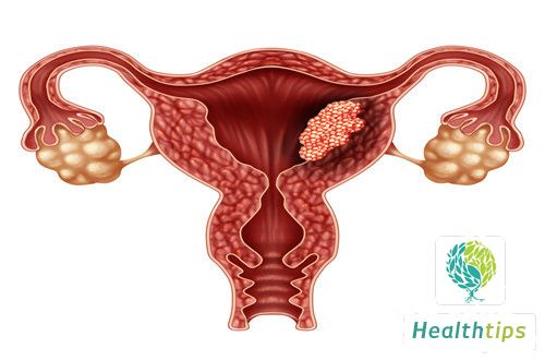 Is Endometrial Thickening a Sign of Cancer?