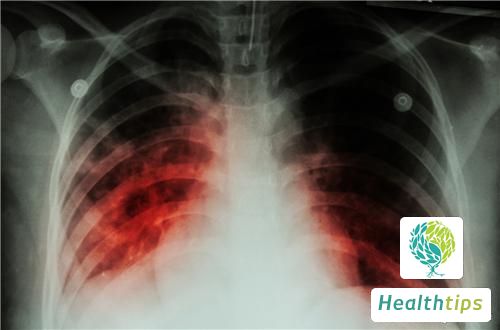 What are the initial symptoms of tuberculosis?