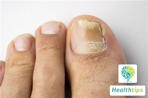 Why Do Nail Fungus Develop?