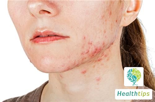 How Long Does It Take for Acne Scars to Fade Away?