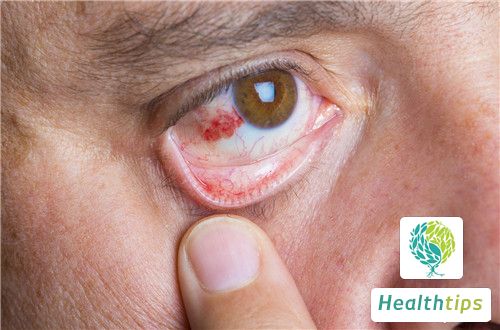 How to Relieve the Symptoms of Conjunctivitis?