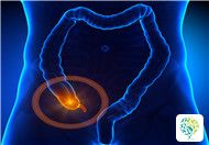 What Are the Causes of Appendicitis?