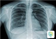 How Are Tuberculosis Mainly Spread and Transmitted?