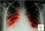 What are the Symptoms of Tuberculosis?