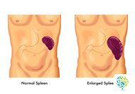 What Are the Differences between Spleen Yang Deficiency and Spleen Yin Deficiency?