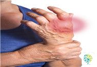 How to Care for Rheumatoid Arthritis?