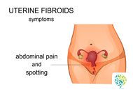 What Are the Early Symptoms of Cervical Cancer Related to Cervical Erosion?