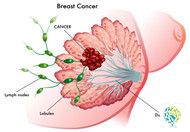 What Foods Should Be Avoided for Breast Hyperplasia?