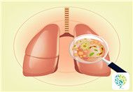 What Are the Alternative Remedies for Tuberculosis?