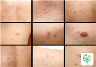 How to Cope with Eczema? Useful Tips to Know