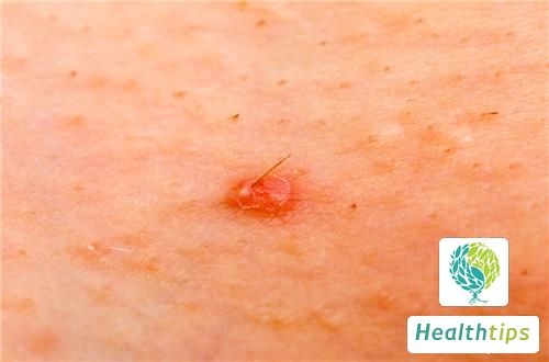 What Could Be the Cause of Small White Spots on the Body?