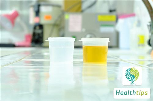 What Does a High Urinalysis Bacteria Count of Over 2000 Mean, and What Should I Do?