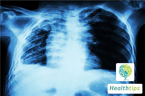 What Does Pulmonary Fibrous Proliferative Lesion Mean?