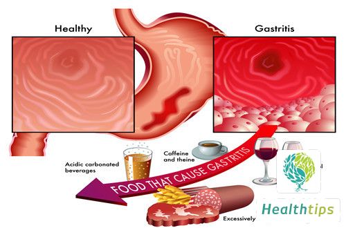 How to Treat Chronic Non-Atrophic Gastritis with Erosion?