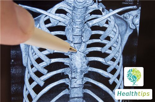 Is a Compression Fracture of the 12th Thoracic Vertebra Serious? Are There Potential Long-Term Effects?