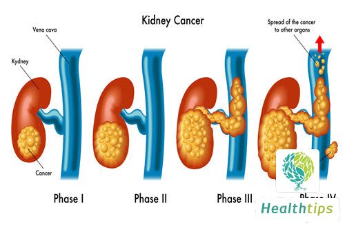 What Are the Recommended Foods for Kidney Inflammation Patients?