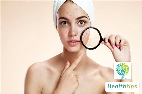 How to Remove Acne Scars Left by Pimples?